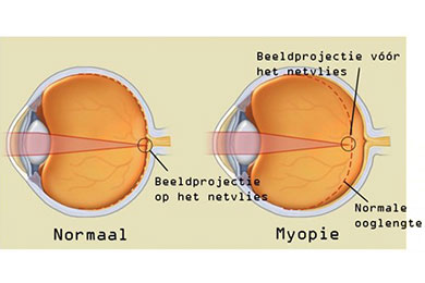 Myopie behandeling bij kinderen