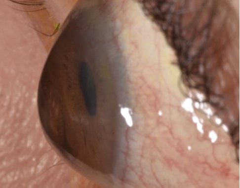 Keratoconus Contactlenscentrum-WFG