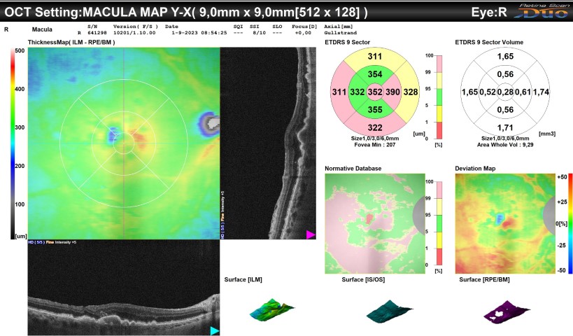 Scans van Macula Degeneratie