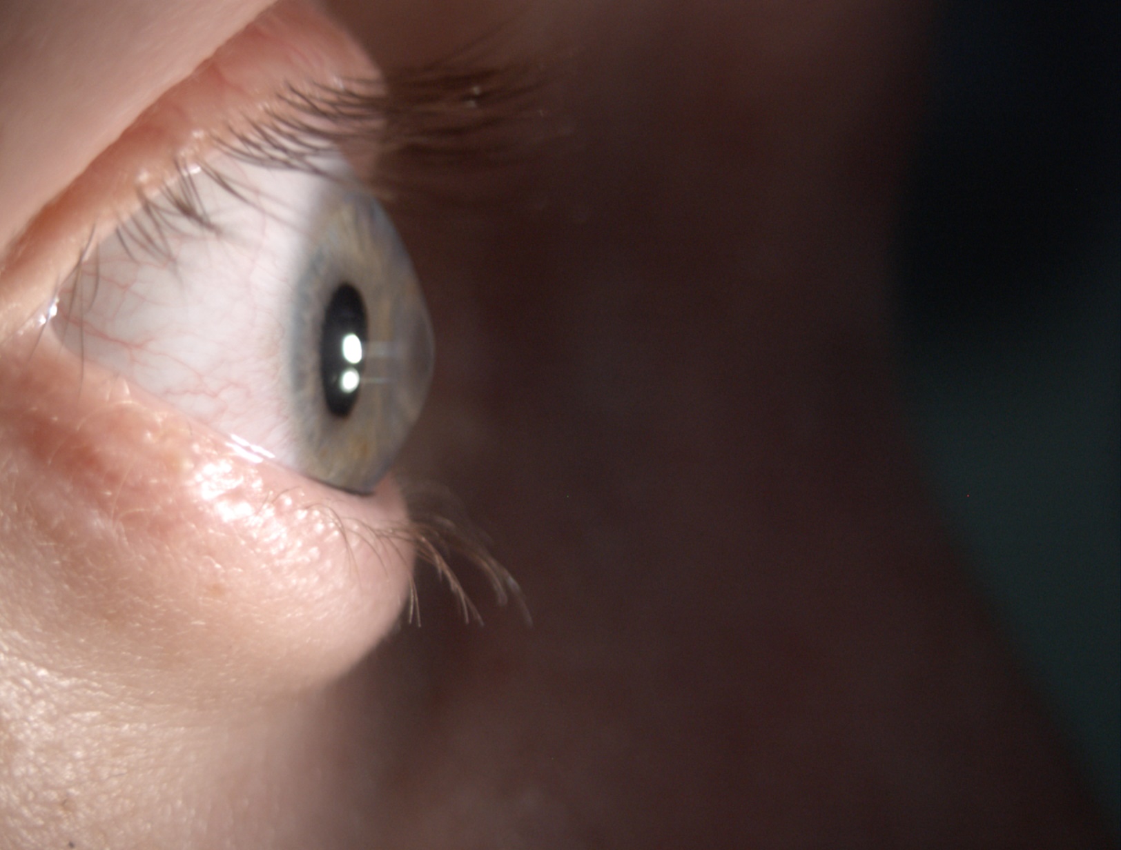 Keratoconus, het hoornvlies stulpt uit in een punt naar voren